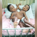 The Epic Siamese Surgery And The Hope For Nigerian Healthcare